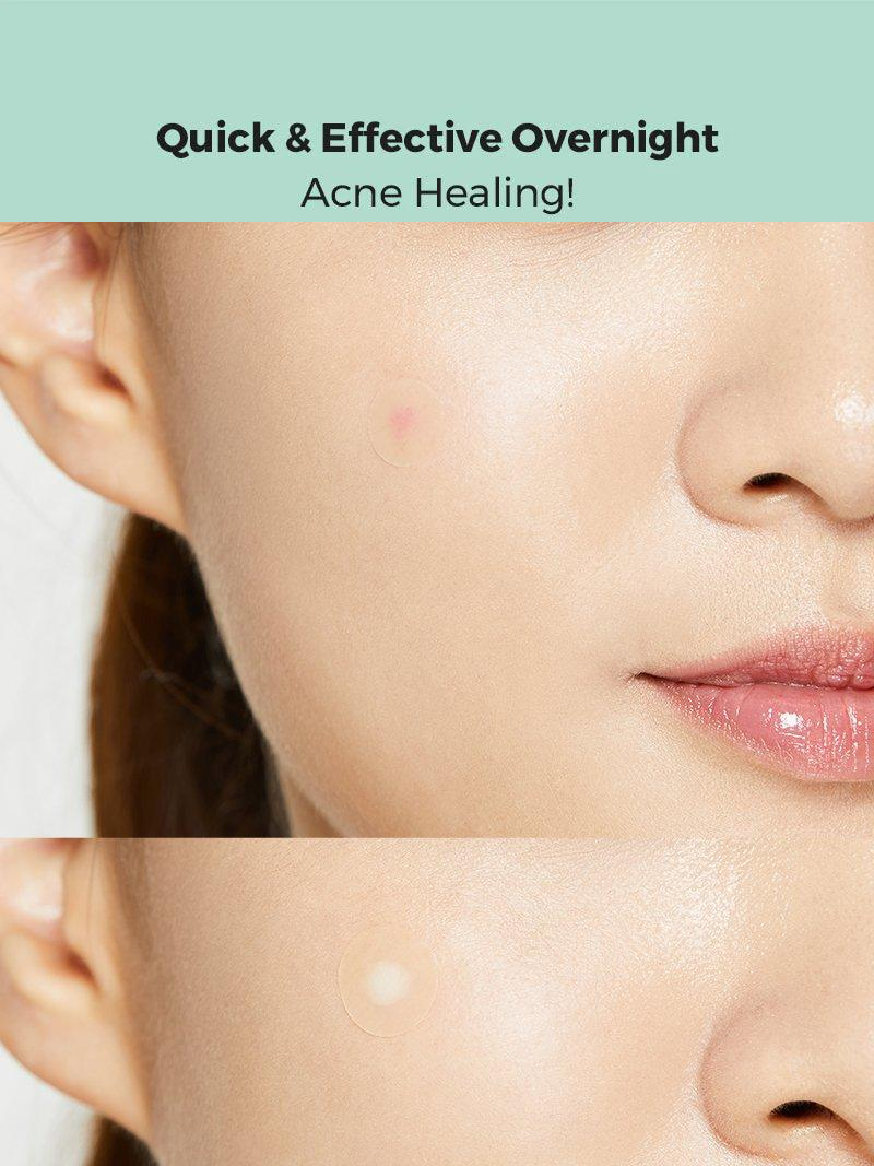 Acne Pimple Master Patch
